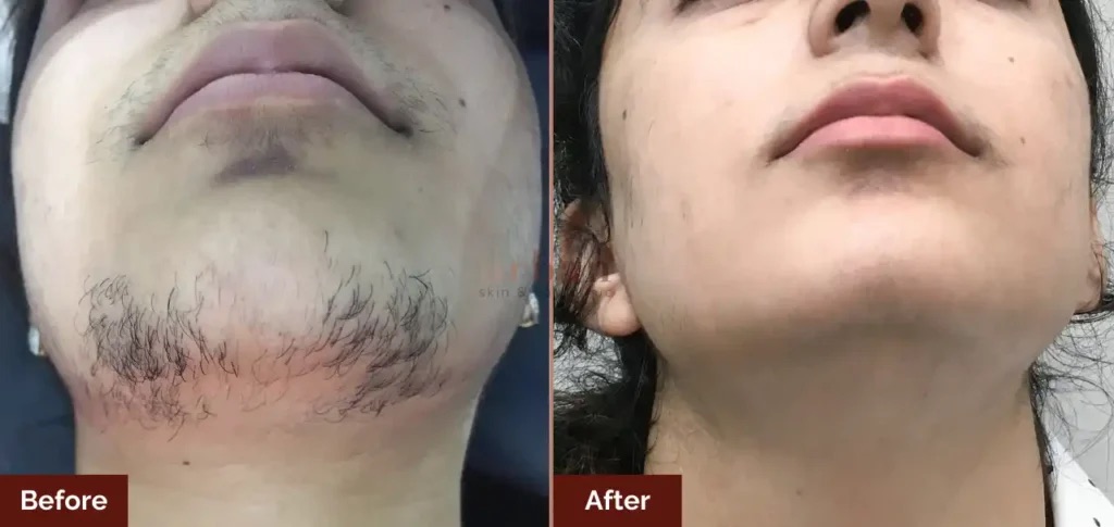Permanent Hair Reduction Therapy